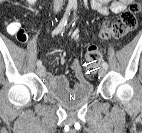 Follow The Stream Imaging Of Urinary Diversions Radiographics