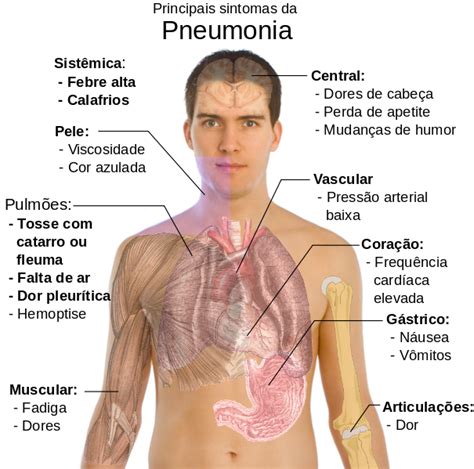 Pneumonia Sintomas Tratamentos E Causas Dermaweb My Xxx Hot Girl