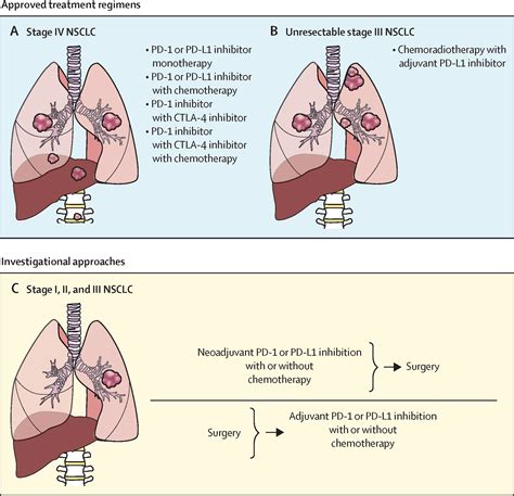 Lung Cancer The Lancet