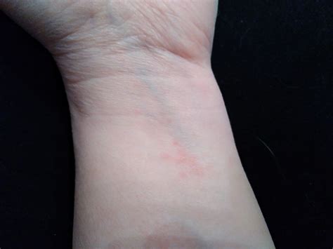 What Is This Rash On The Inside Of My Left Wrist Dermatologyquestions