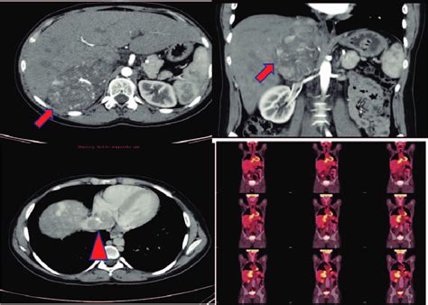 Axial And Coronal Cuts Of A Contrast Enhancing Ct Scan Of The Abdomen