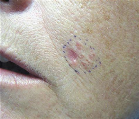 Figure 1 From Squamous Cell Carcinoma Arising In Nevus Comedonicus