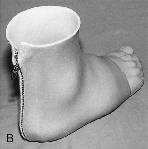 Orthotic And Prosthetic Devices In Partial Foot Amputations Foot And