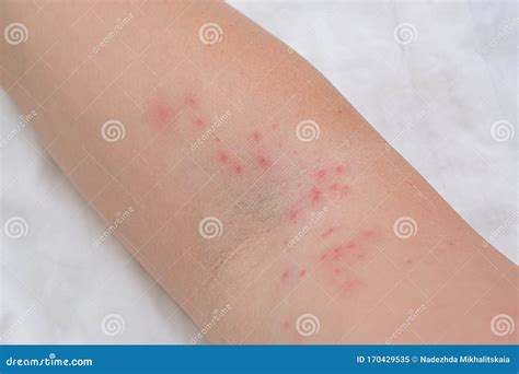 Itchy Bumps On Arms Shop Cheapest Save 57 Jlcatjgobmx