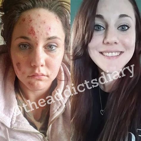 Inspiring Transformations Of Drug Addicts Before And After Getting