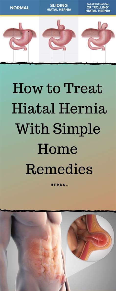 How To Treat Hiatal Hernia With Simple Home Remedies Remedies Home