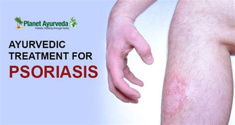 Treatment Of Psoriasis With Ayurveda