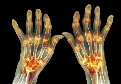 Rheumatoid Arthritis Flares Forewarned By Blood Levels Of Newly