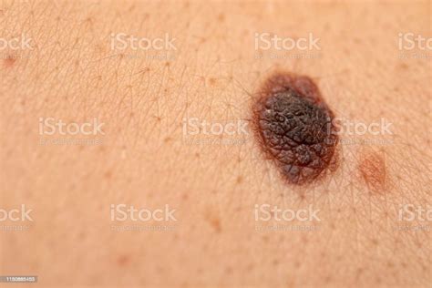 Dangerous Nevus On Skin Melanoma Stock Photo Download Image Now Istock
