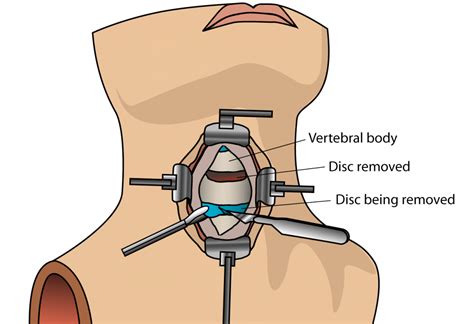 Anterior Cervical Discectomy ACDF Surgery All You Need To Know