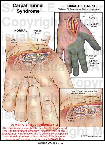 Carpal Tunnel Syndrome Medical Illustration Medivisuals