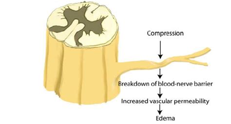 Nerve Root Compression Produces Increased Vascular Permeability At The