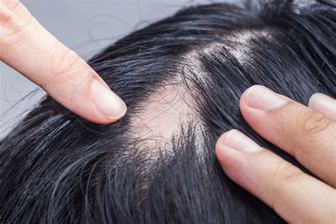Alopecia Areata Causes Diagnosis And Treatment Wimpole Clinic