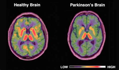 Parkinsons Disease Is A Nightmare Full Of Nightmares And