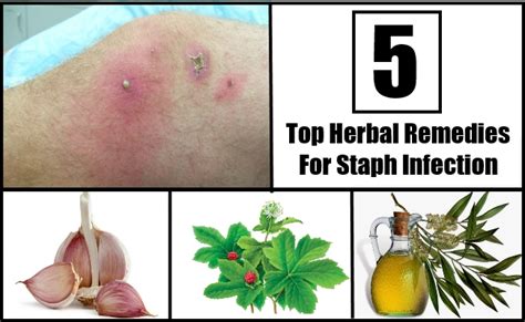 Top 5 Herbal Remedies For Staph Infection Natural Home Remedies