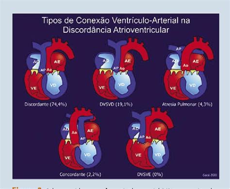 Pdf Atrioventricular Discordance Associated To Double Outlet Right