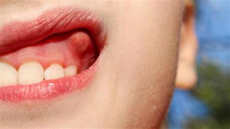 How To Cure A Tooth Abscess Or With 11 Home Remedies Step To Health
