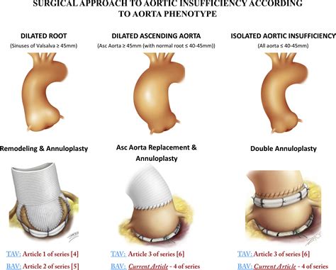 Isolated Bicuspid Aortic Valve Repair With Double Annuloplasty How I Teach It The Annals Of