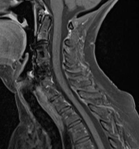 Fat Suppression Techniques For 3 T Mr Imaging Of The Musculoskeletal