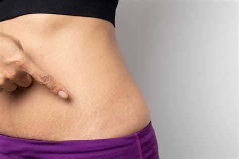 Stretch Marks During And After Pregnancy And What To Expect