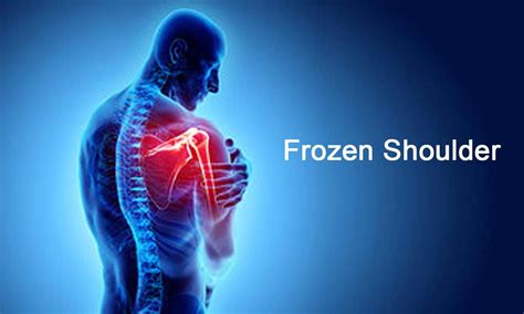 Frozen Shoulders Treatment Kevaline Physiotherapy And Osteopathy Clinic