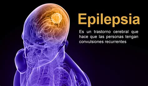 ¿qué Es La Epilepsia El Visitante