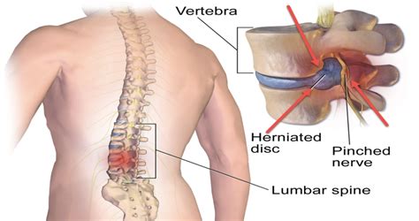 Is It A Herniated Disc A Bulging Disc Or A Pinched Nerve Accent On