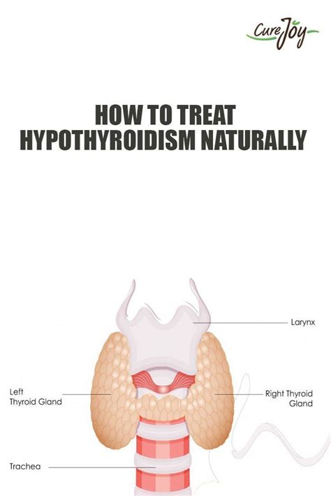 How To Treat Hypothyroidism Naturally With Images Hypothyroidism Thyroid Treatment
