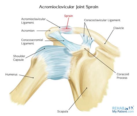 Superior, middle and inferior ligaments, connect the glenoid to the anatomical neck of the humerus an. Acromioclavicular Joint Sprain | Rehab My Patient