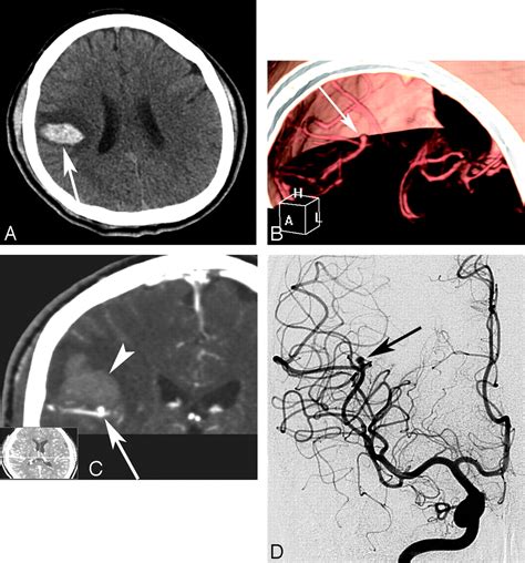 Multidetector Row Ct Angiography In Spontaneous Lobar Intracerebral