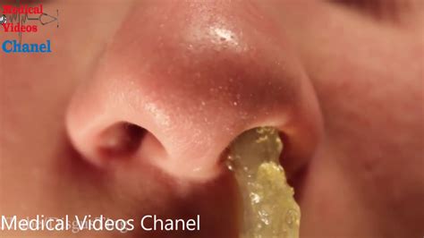 Medical Huge Booger Inside Nose Removal Medical Youtube