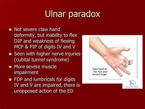 Claw Hand And Ulnar Paradox How To Relief Hand Therapy Hand Anatomy