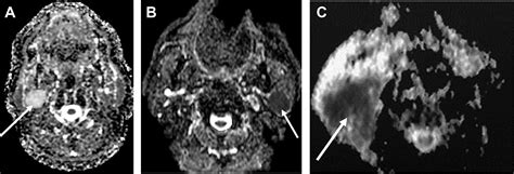 Mr Imaging Of Salivary Gland Tumors Magnetic Resonance Imaging Clinics