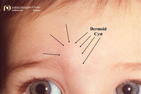 Dermoid Cysts Once Upon A Time Academic Dermatology Of Nevada