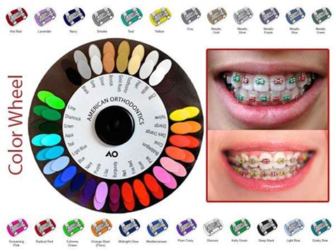Afterwards, everything will go back to normal. Braces Color Wheel Power Chain in 2020 | Braces colors ...