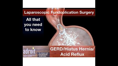 Acid Reflux Gerd Hiatus Hernia Heartburn And Acidity Treatment And