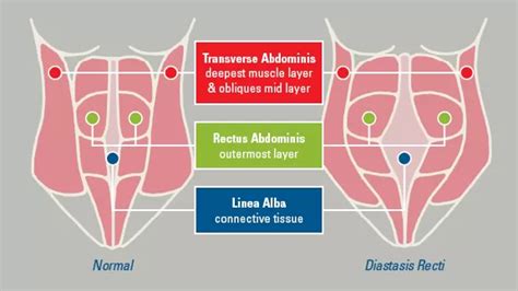 Diastasis Recti Abdominus Separation Of The Abdominal Muscles