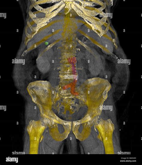 Color Enhanced Three Dimensional Ct Scan Image Of An 80 Year Old Obese