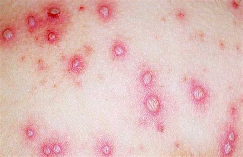 Eczema Pimple Like Bumps Dorothee Padraig South West