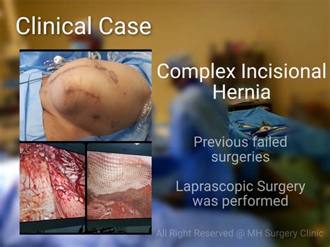 Complex Incisional Hernia Surgery