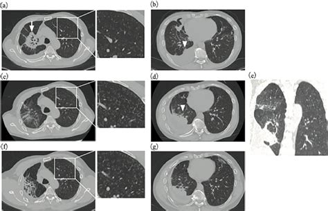 Figure1computed Tomography Ct Findings Of The Patients Lungs Axial