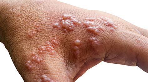 What Is Shingles With Pictures Queensland Health