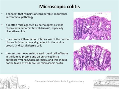 Microscopic Colitis And Focal Active Colitis Whats New Ppt Download