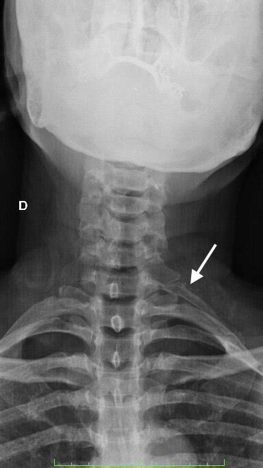 Anteroposterior Cervical X Ray From The Second Case Showing A Cervical