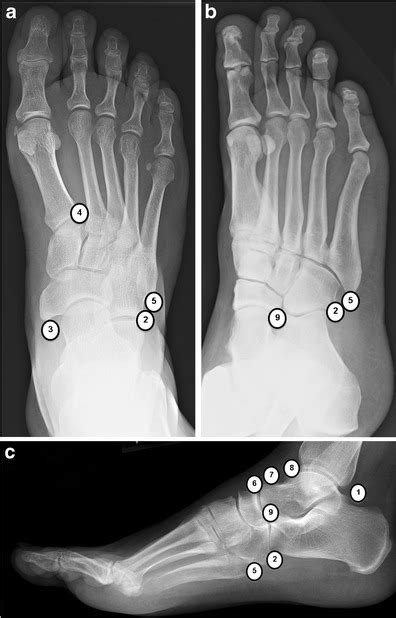 Accessory Ossicles Of The Foot Ap A Oblique B And Lateral C