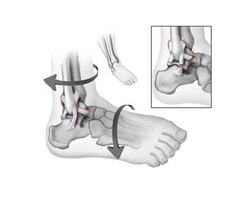 Foot And Ankle Doctors Surgery Rehabilitation Midwest Bone And Joint