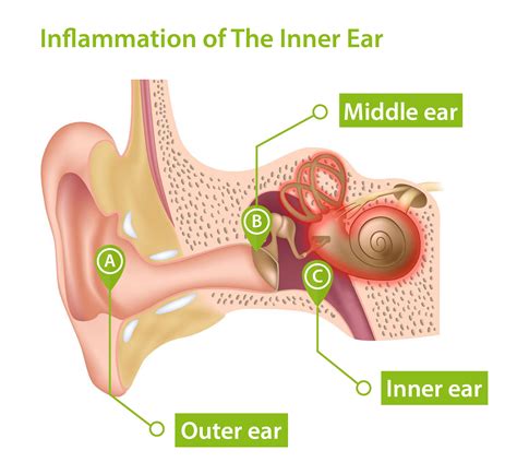 Labyrinthitis What You Should Know Connect Hearing