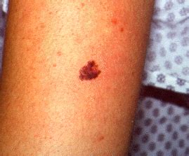 Skin Cancer Spots On Arm Vrogue Co