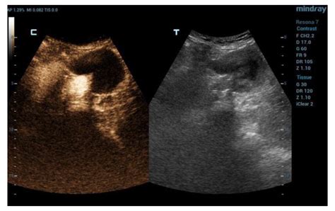 Diagnostics Free Full Text Role Of Contrast Enhanced Ultrasound In