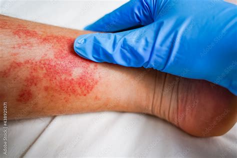 Disease Of The Skin On The Legs Itchy Red Rashes And Spots Stock Photo
